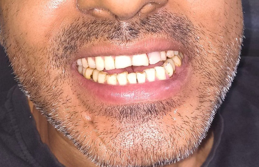 After dental implant treatment at Bhati Dental Clinic